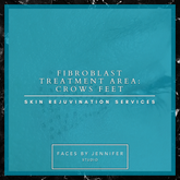 Fibroblast Treatment Area: Crows Feet