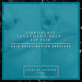 Fibroblast Treatment Area: Lip Flip
