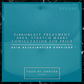 Fibroblast Treatment Area: Stretch Marks Consultation for price