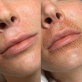 Fibroblast Treatment Area: Lip Flip