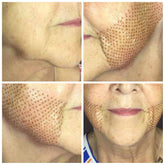 Fibroblast Treatment Area: Mid Lift