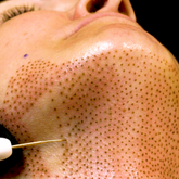 Fibroblast Treatment Area: Neck