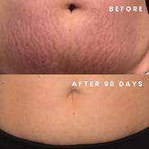 Fibroblast Treatment Area: Stretch Marks Consultation for price