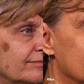 Fibroblast Treatment Area: Sun Spots / Age spots