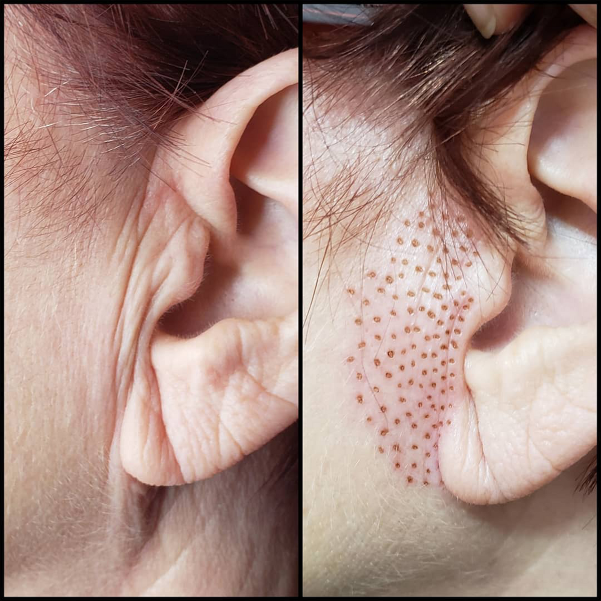 Fibroblast Treatment Area: Before Ear Wrinkles