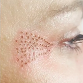 Fibroblast Treatment Area: Crows Feet