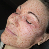 Fibroblast Package: Full Face