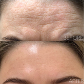 Fibroblast Treatment Area: Forehead