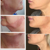 Fibroblast Treatment Area: Jaw Line with mid neck