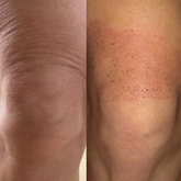 Fibroblast Treatment Area: Knees