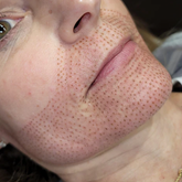 Fibroblast Package: Lower Face