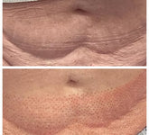 Fibroblast Treatment Area: Stomach