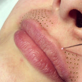 Fibroblast Treatment Area: Upper Lips or Lip Flip
