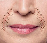 Fibroblast Treatment Area: Nasiolabial Lines