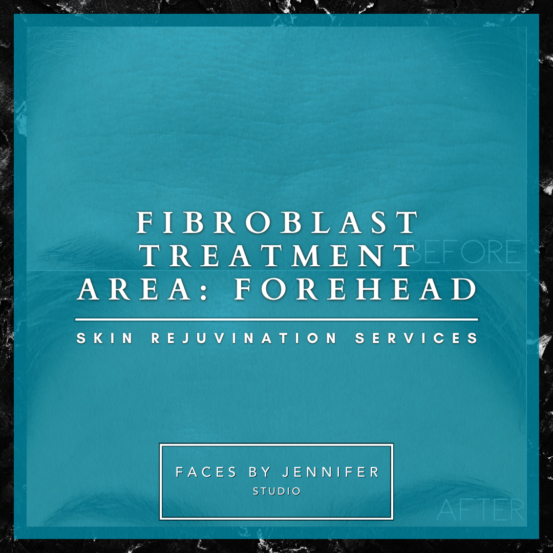 Fibroblast Treatment Area: Forehead