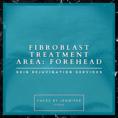 Fibroblast Treatment Area: Forehead