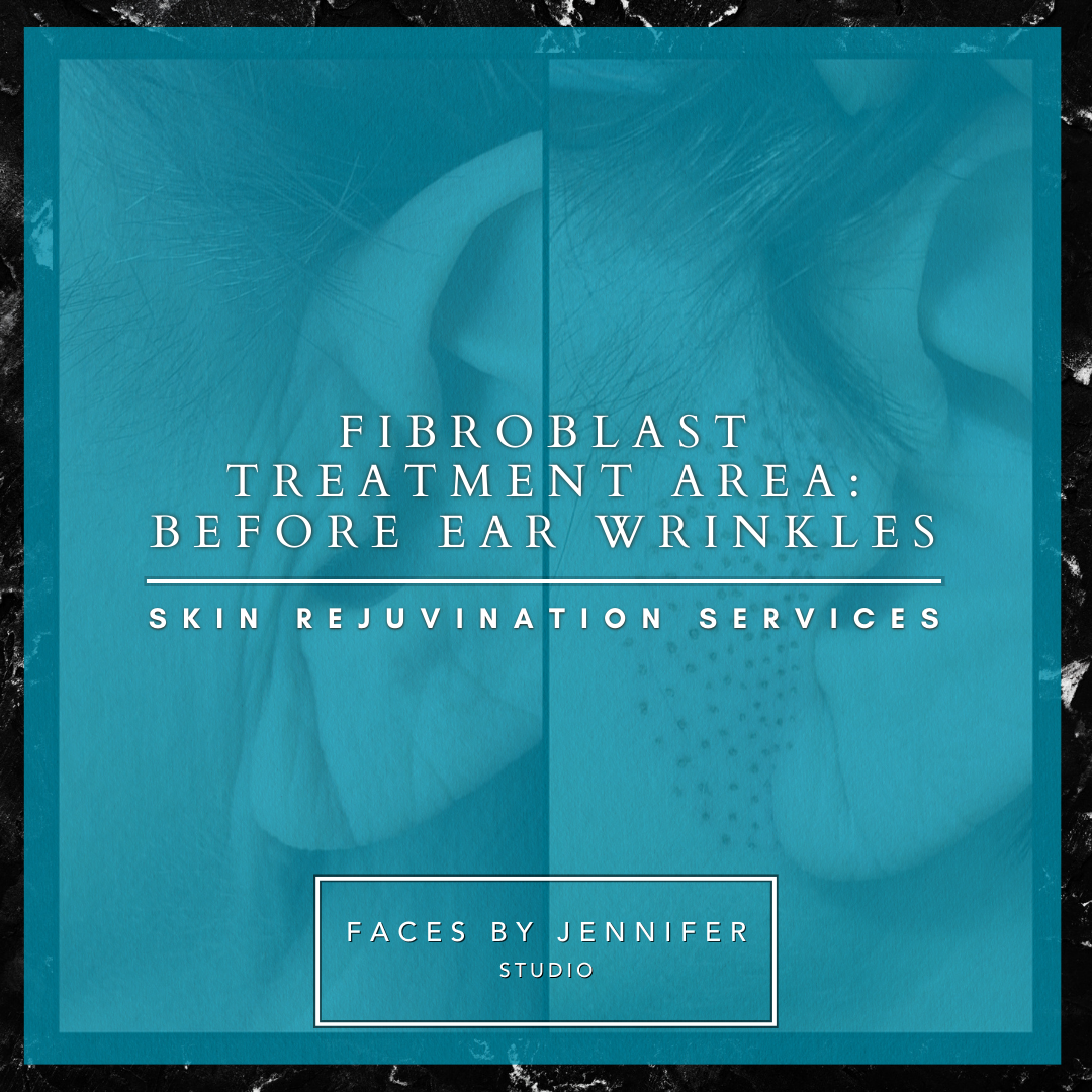 Fibroblast Treatment Area: Before Ear Wrinkles