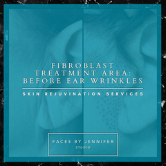 Fibroblast Treatment Area: Before Ear Wrinkles