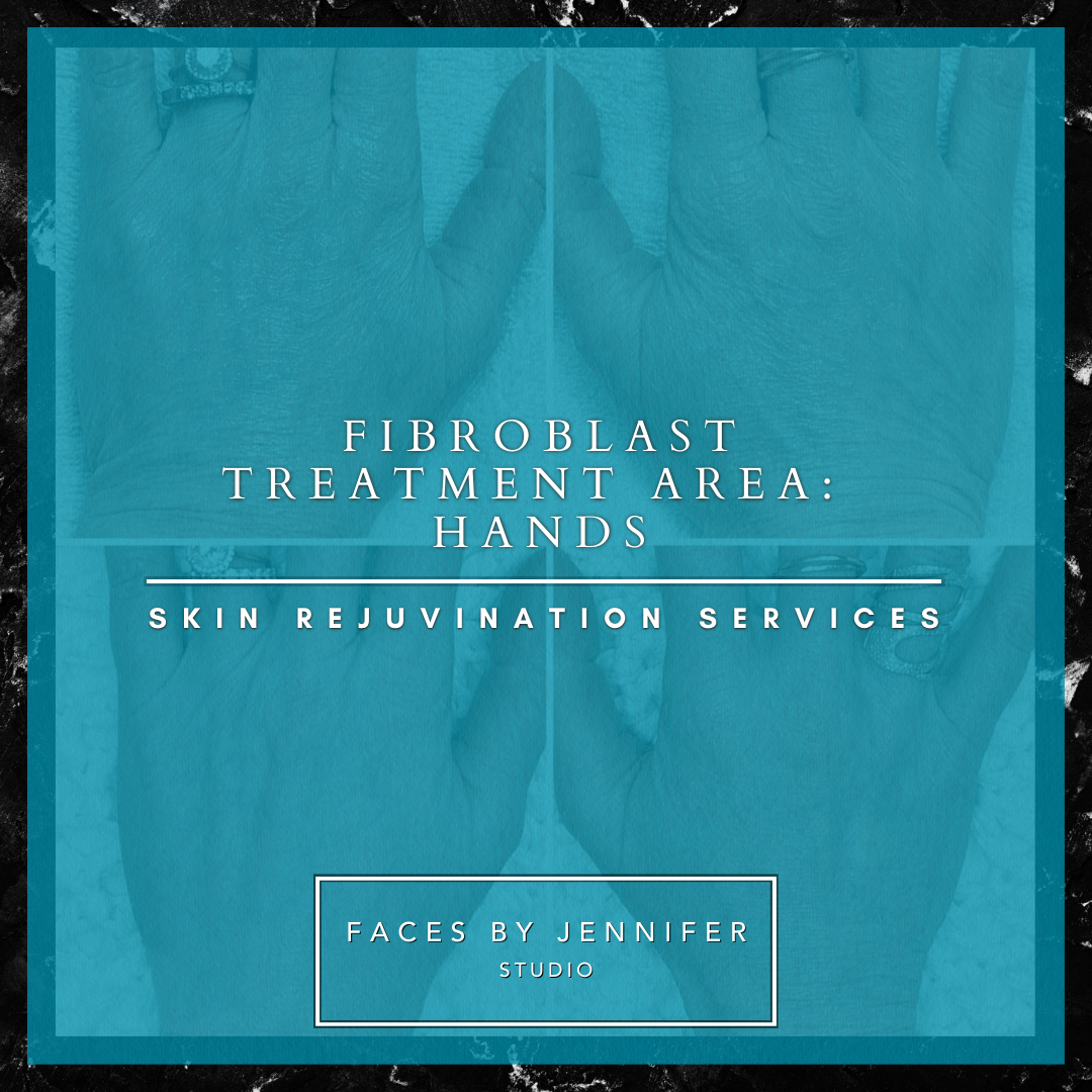 Fibroblast Treatment Area: Hands