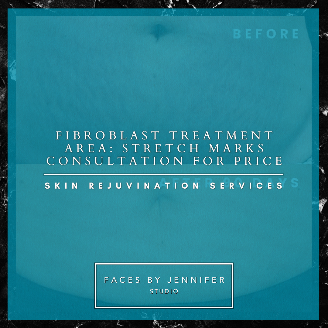 Fibroblast Treatment Area: Stretch Marks Consultation for price