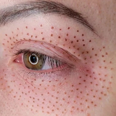 Fibroblast Package: Full Eye