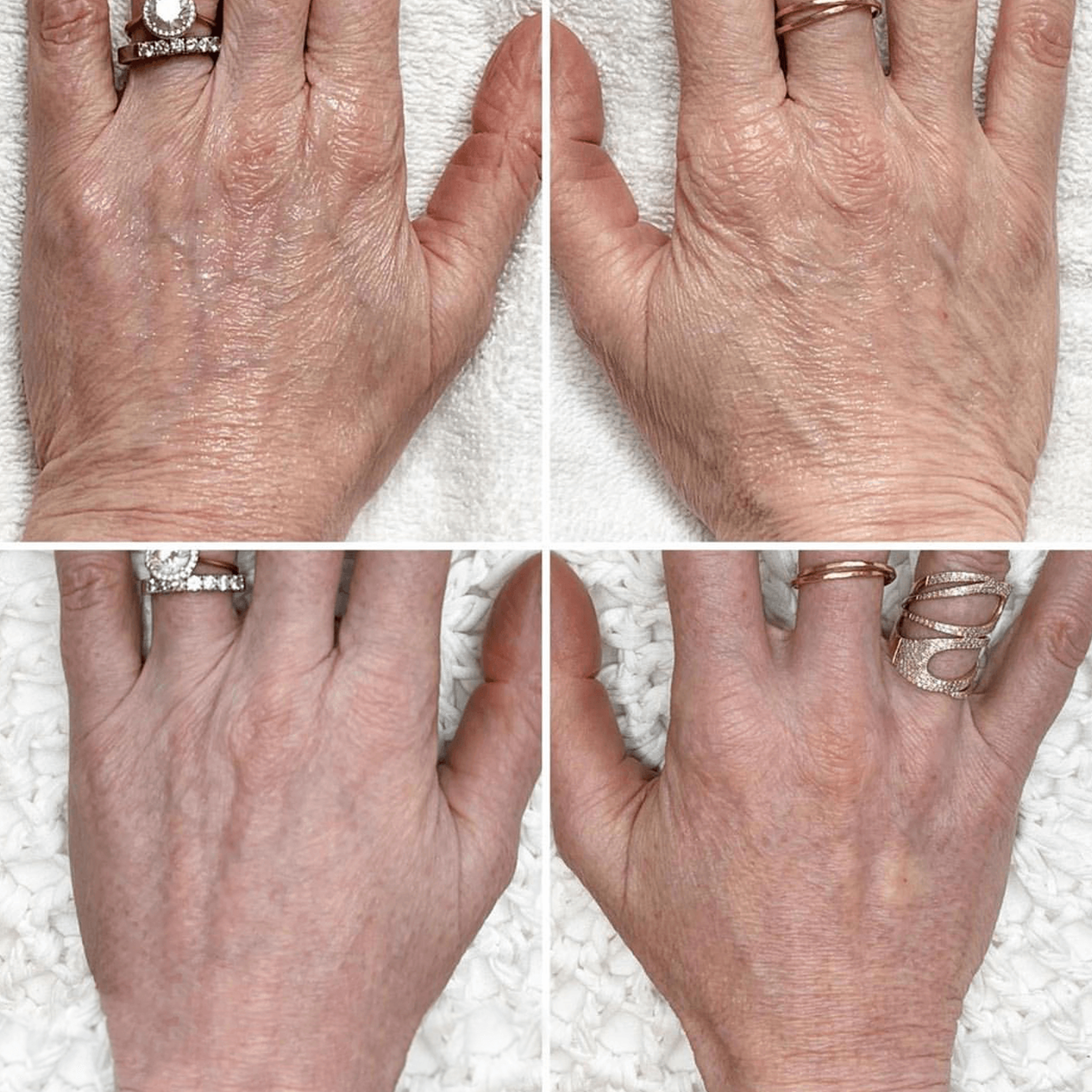 Fibroblast Treatment Area: Hands