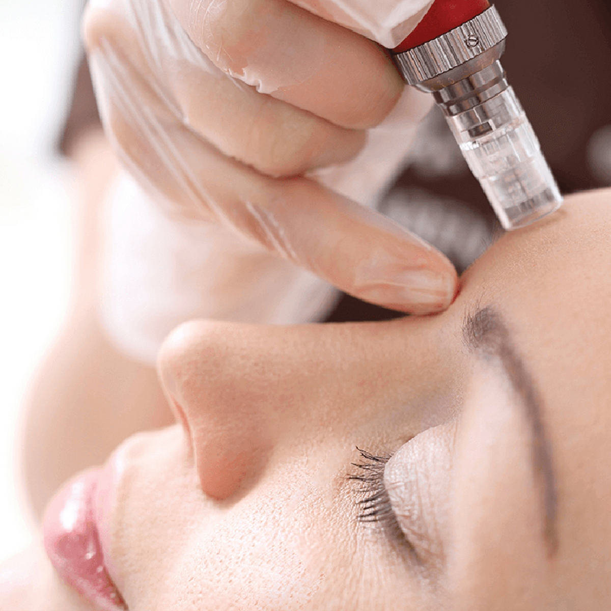 Microneedling  Package Three Sessions