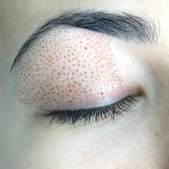 Fibroblast Treatment Area: Upper Eye Lid